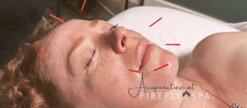 Acupuncture at FIrefly Spa in Mission Hills San Diego. 